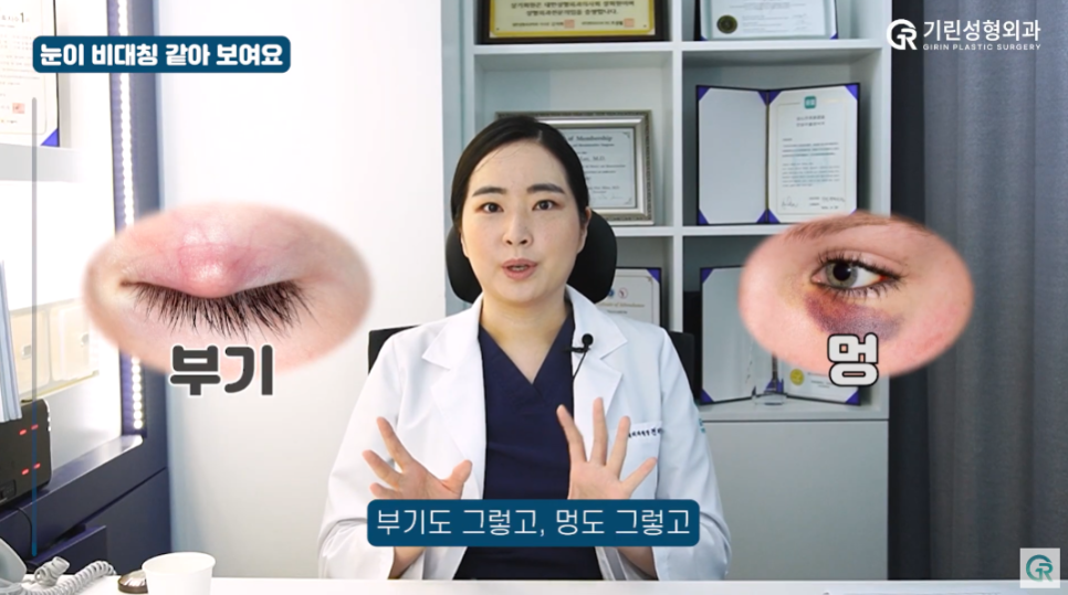 [기린성형외과] "쌍수 망한건가요?"_눈수술 부작용 주의사항 Q&A 관련 이미지 3