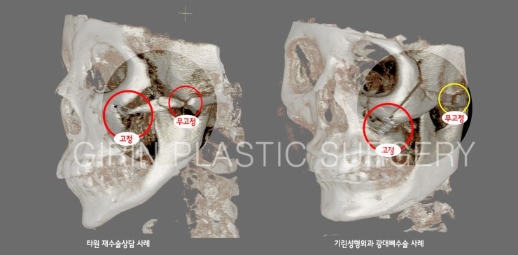 광대뼈수술 시 나사고정위치와 고정갯수가 안전에 영향을 주나요? 관련 이미지 2