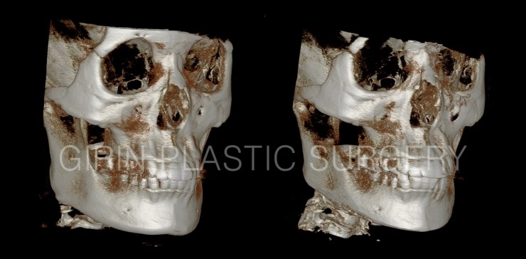 넓은턱 수술사례 관련 이미지 2