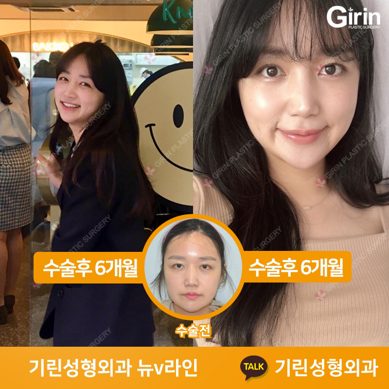 [뉴브이라인] 45도 라운딩 브이라인 절골술로 작은 얼굴 만들기 관련 이미지 8