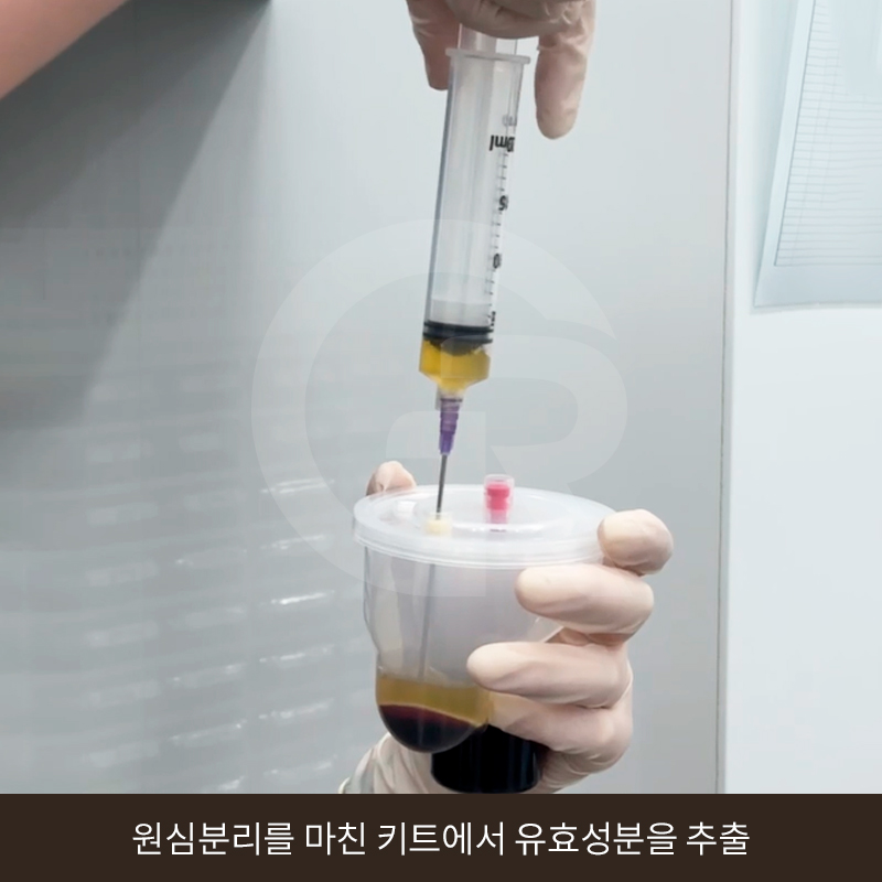 탈모 고민 두피 줄기세포 치료, 가격이 다른 이유는? 관련 이미지 7