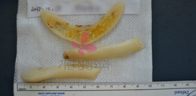 앞턱수술 : 앞턱수술로 긴턱줄임효과(수술후bone) 관련 이미지 1