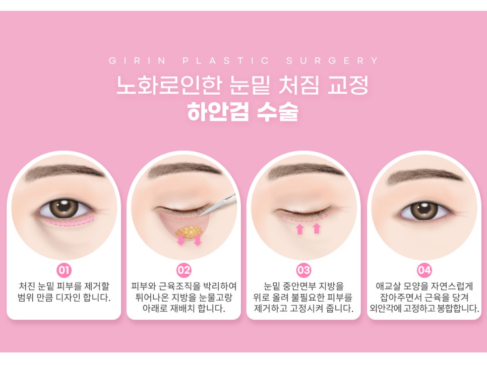 중년눈수술 어려지는 방법 중 하나? 관련 이미지 12