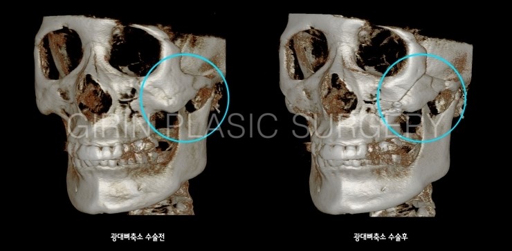 45도광대, 옆광대축소수술 전후 3DCT비교 관련 이미지 2
