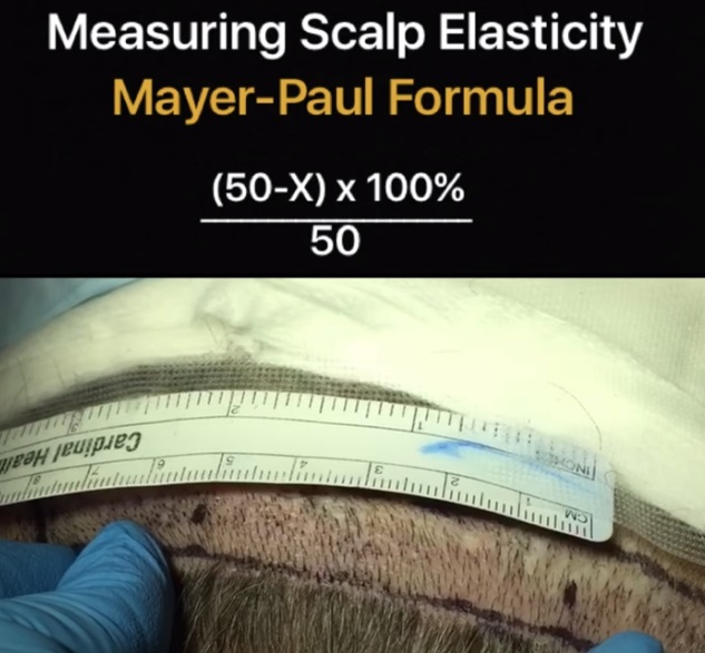 [공유] 이마축소술 두피탄력도 측정? 정말 그렇게 하는게 맞아요? 저는 몇 센티를 줄일 수 있나요? 관련 이미지 6