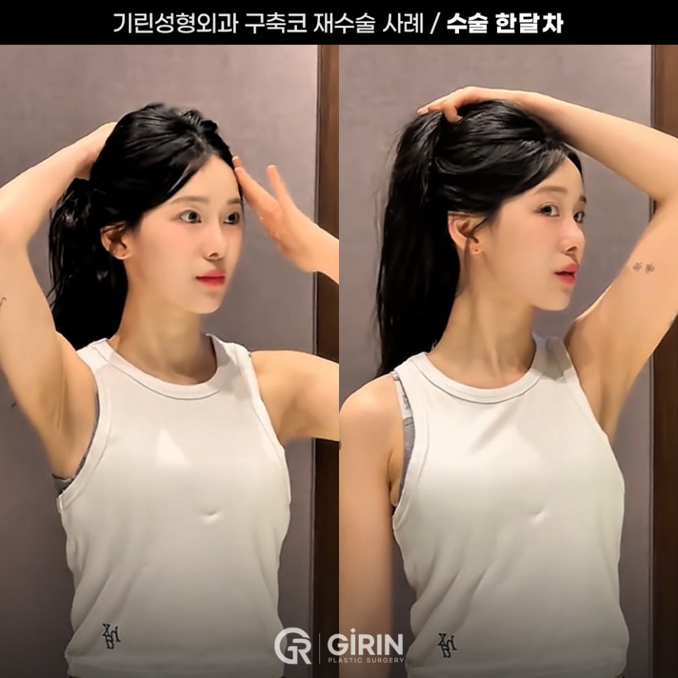 기린성형외과 코성형 구축코 재건 사례 관련 이미지 7