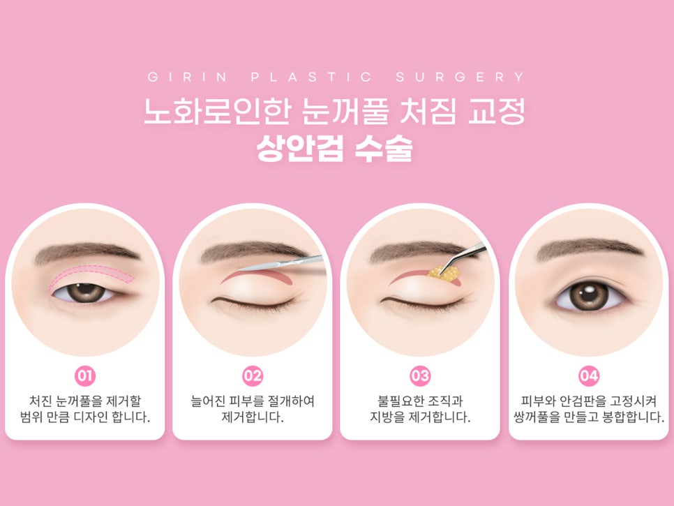 중년눈수술 어려지는 방법 중 하나? 관련 이미지 8