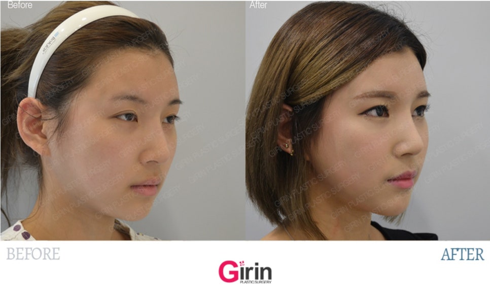 요즘 누가 티나게 성형하니? 기린성형외과 자연유착으로 미모완성♥(+후기) 관련 이미지 9