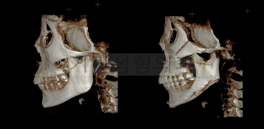 사각턱+앞턱+광대고정술 CASE 관련 이미지 3