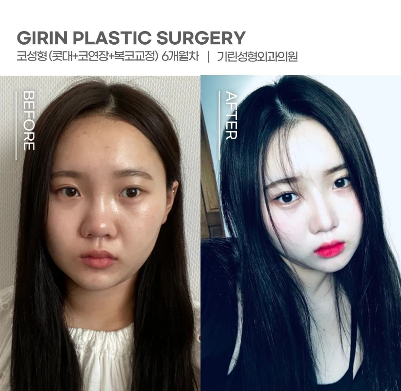 콧볼축소술 뭉툭한 코 개선을 위해 관련 이미지 2