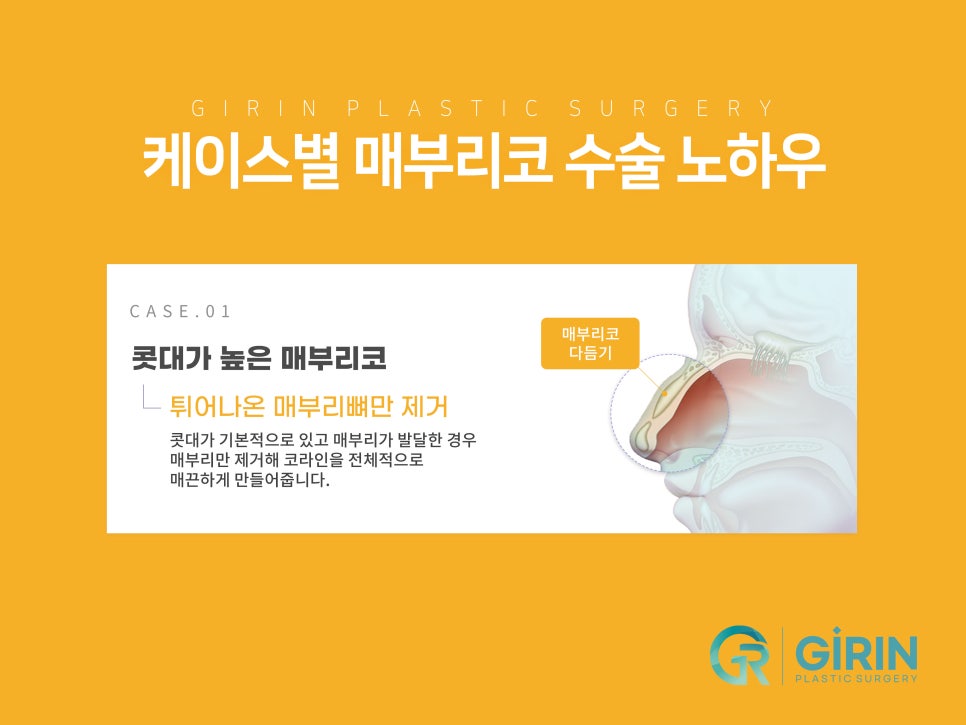 여자코성형후기 얼굴 비율까지 고려하여 관련 이미지 10
