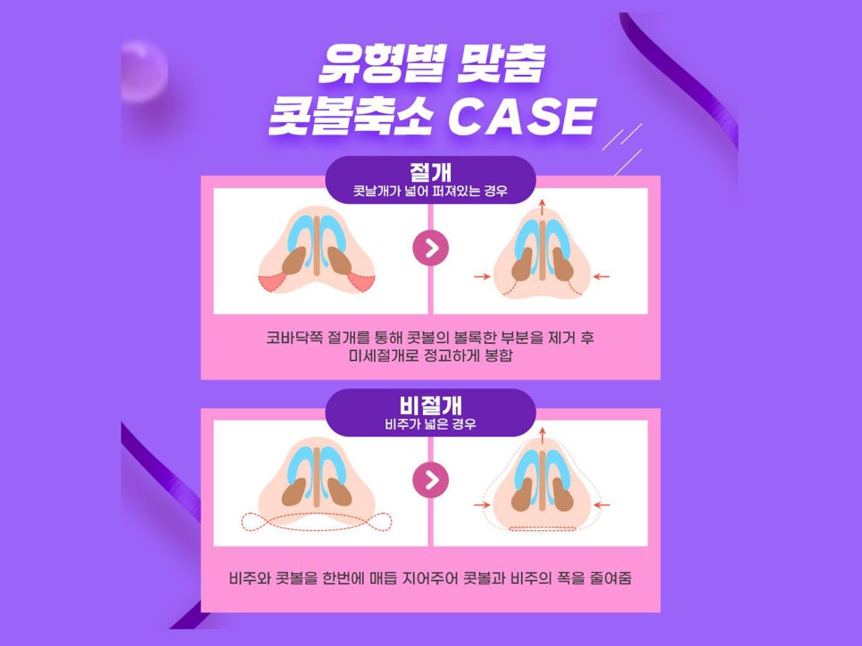 비절개콧볼축소수술 자연스럽고 예쁜 코 만들기 관련 이미지 3