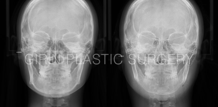 광대고정, 긴곡선절제(넓은턱) 케이스 관련 이미지 4