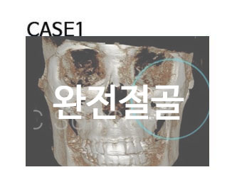 케이스에 맞는 광대뼈축소술 관련 이미지 2
