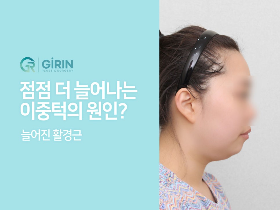 이중턱지방흡입 고려하고 있다면 관련 이미지 2