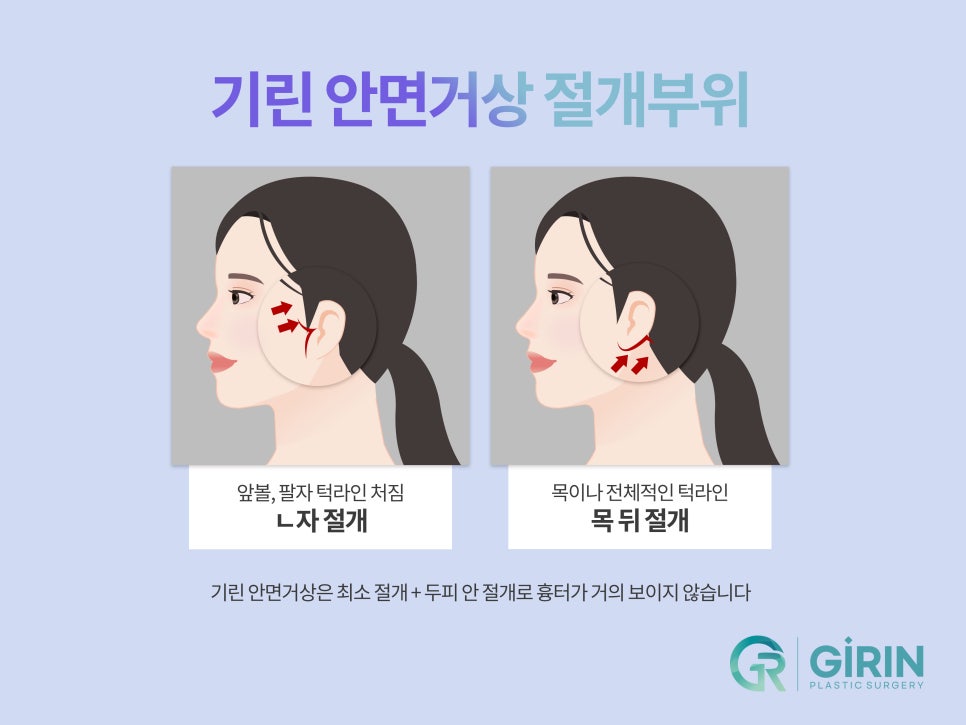 안면거상술효과 기대하는 변화 관련 이미지 8