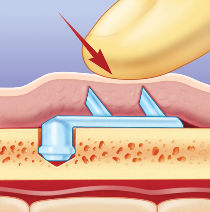 [공유] "이마거상술" 실제 수술은 어떻게 진행되나요? 관련 이미지 7