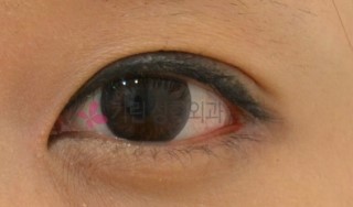 졸린눈 교정 비절개눈매교정! 관련 이미지 3