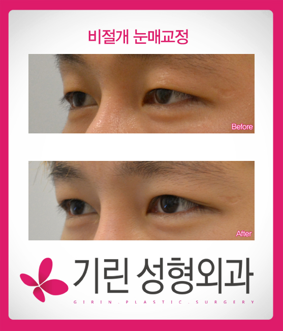 남자쌍꺼풀수술은 자연스럽게(전후사진) 관련 이미지 1