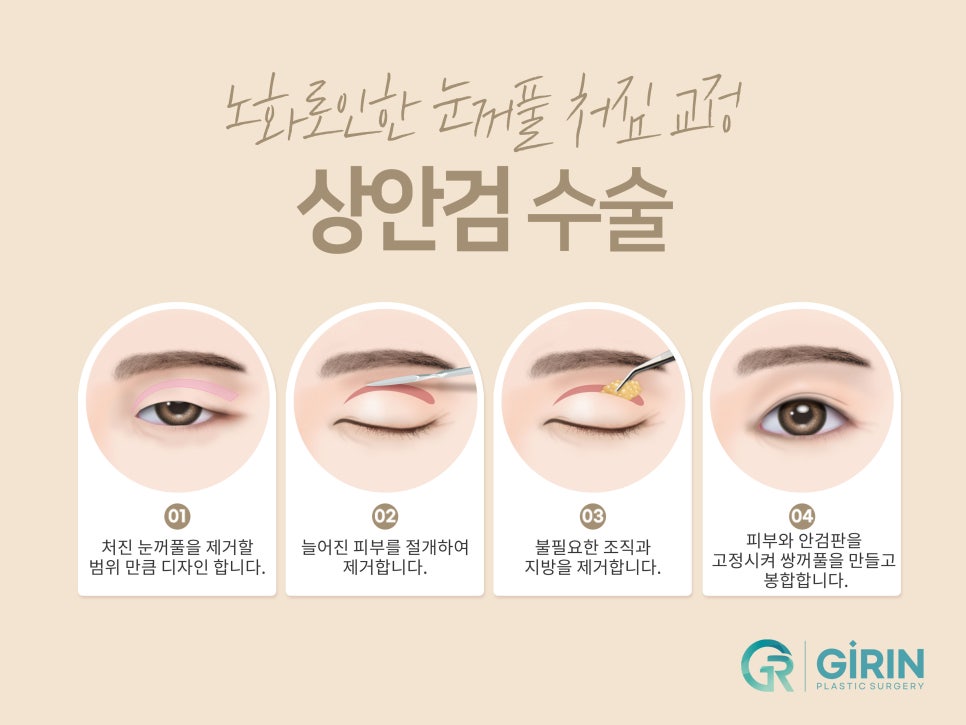 처진눈성형 다시 눈매를 잡아주며 관련 이미지 5