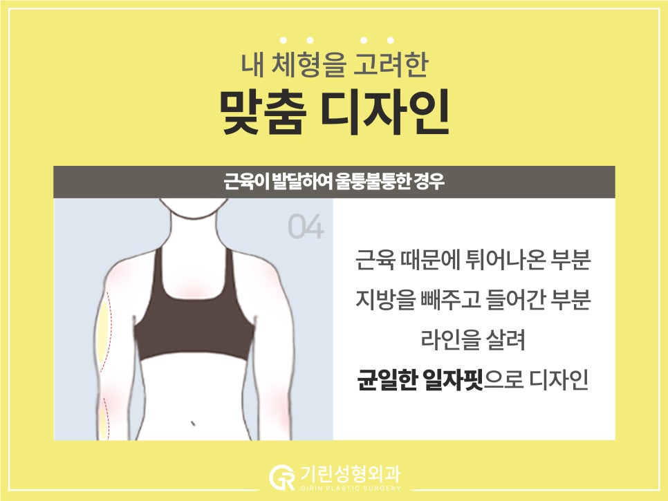 [기린 성형외과] 예쁜 라인 찾는 체형별 팔뚝지방흡입 관련 이미지 9