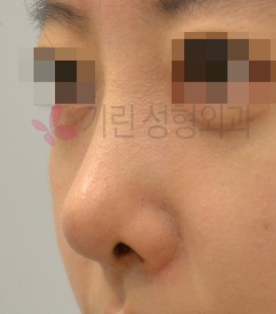 코재수술잘하는곳 : 보형물이 비치는 경우 관련 이미지 3