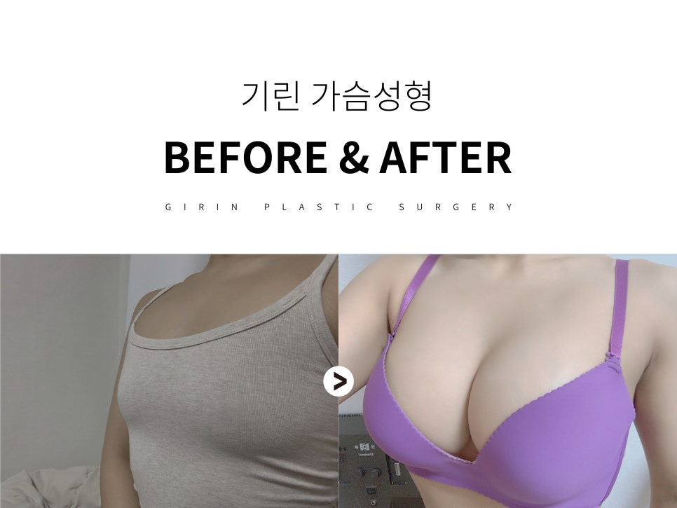 가슴성형잘하는곳 신중하게 보고 관련 이미지 2