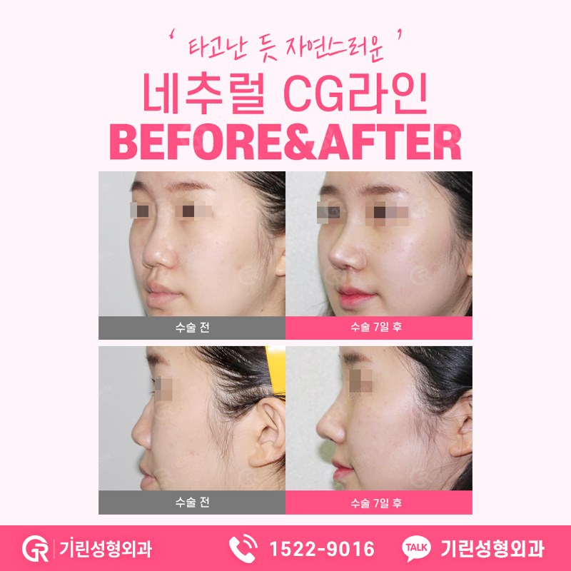 코성형가격 전에 알아야할 것들 관련 이미지 3