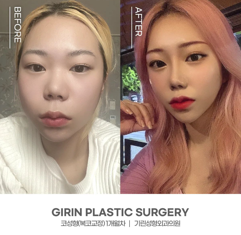 콧볼축소술 뭉툭한 코 개선을 위해 관련 이미지 11