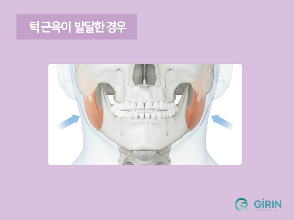 강남이중턱지방흡입 체크할 것 관련 이미지 5
