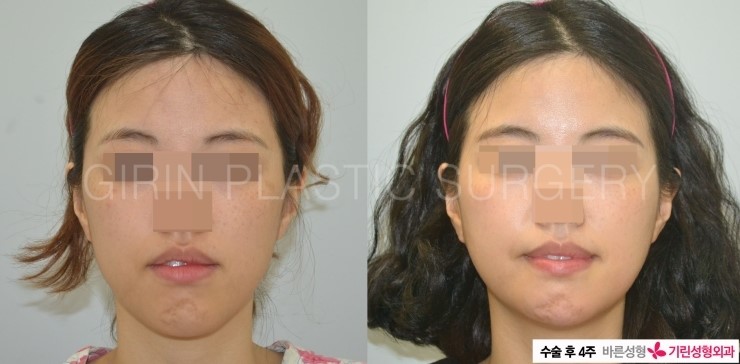 긴곡선브이라인 수술후3주 ->4주 경과 관련 이미지 2
