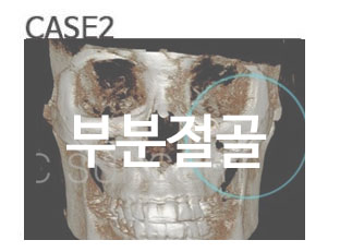 케이스에 맞는 광대뼈축소술 관련 이미지 4