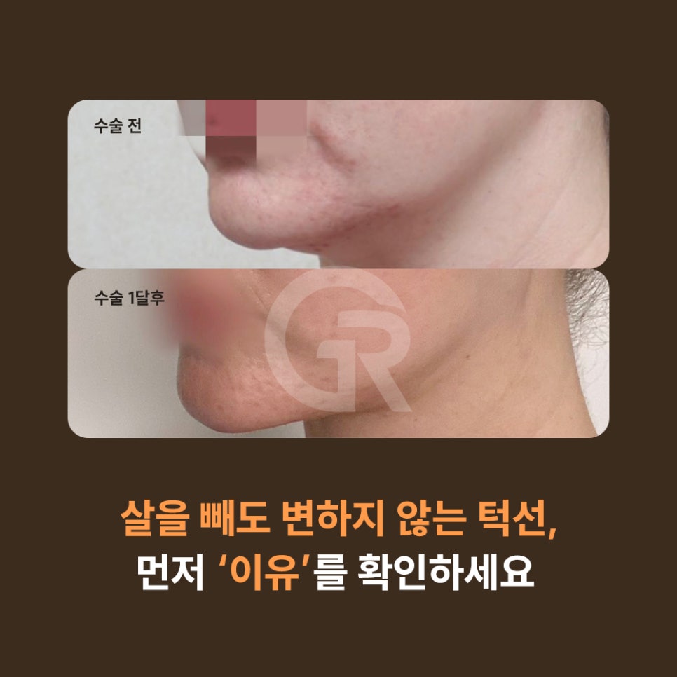 다이어트 후 이중턱은 그대로, 얼굴처짐만 심해졌을 때 해결 방안 관련 이미지 4