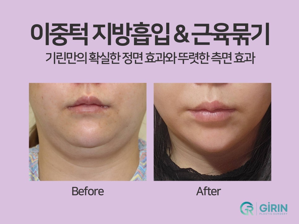 강남이중턱지방흡입 체크할 것 관련 이미지 8