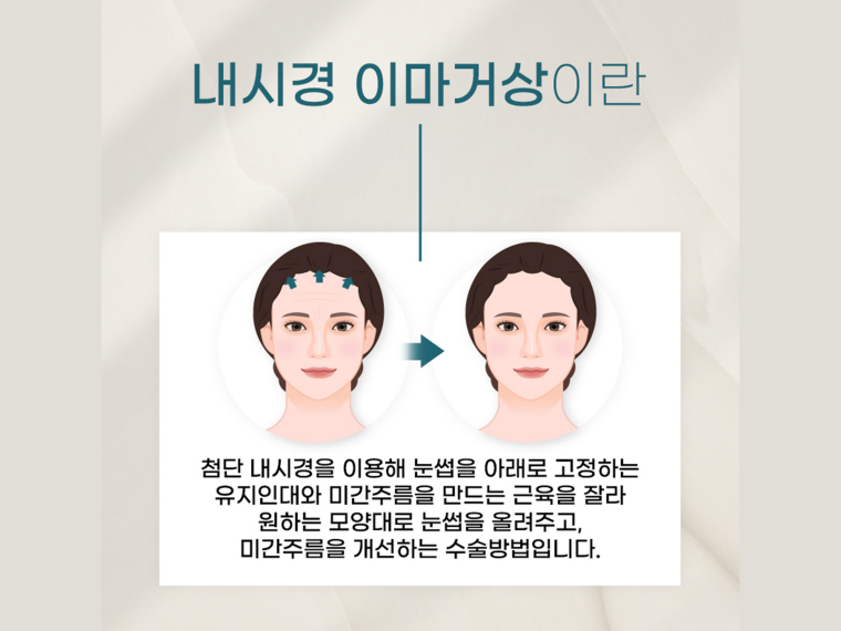 내시경이마거상 탄력 고민을 해결하는 관련 이미지 2