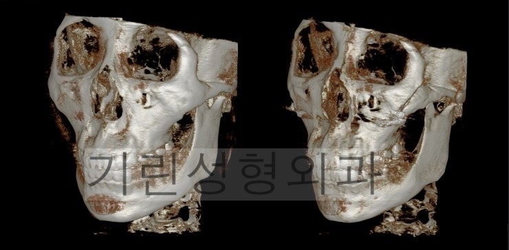 광대뼈고정, 볼처짐 아큐스컬프 사례입니다. 관련 이미지 4