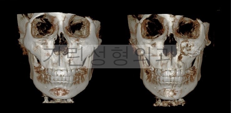광대뼈고정, 볼처짐 아큐스컬프 사례입니다. 관련 이미지 1