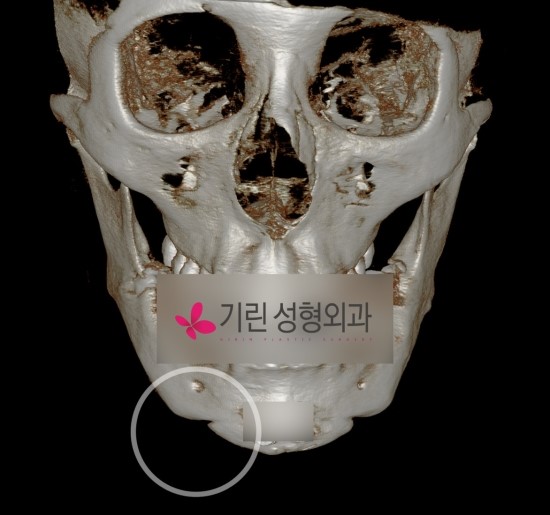 안면윤곽부작용 이차각으로 인한 재수술 관련 이미지 1