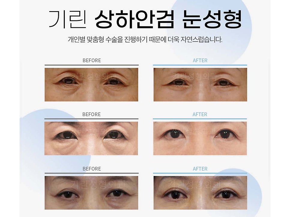 상안검하안검수술 빠른 회복을 위해 관련 이미지 2