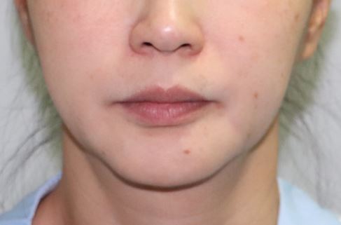 비수술 리프팅, 어떤 종류가 있을까? 관련 이미지 1