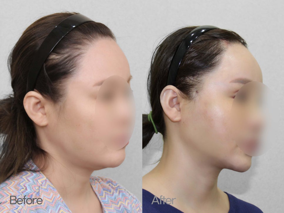 이중턱성형 차이가 궁금하다면 관련 이미지 5