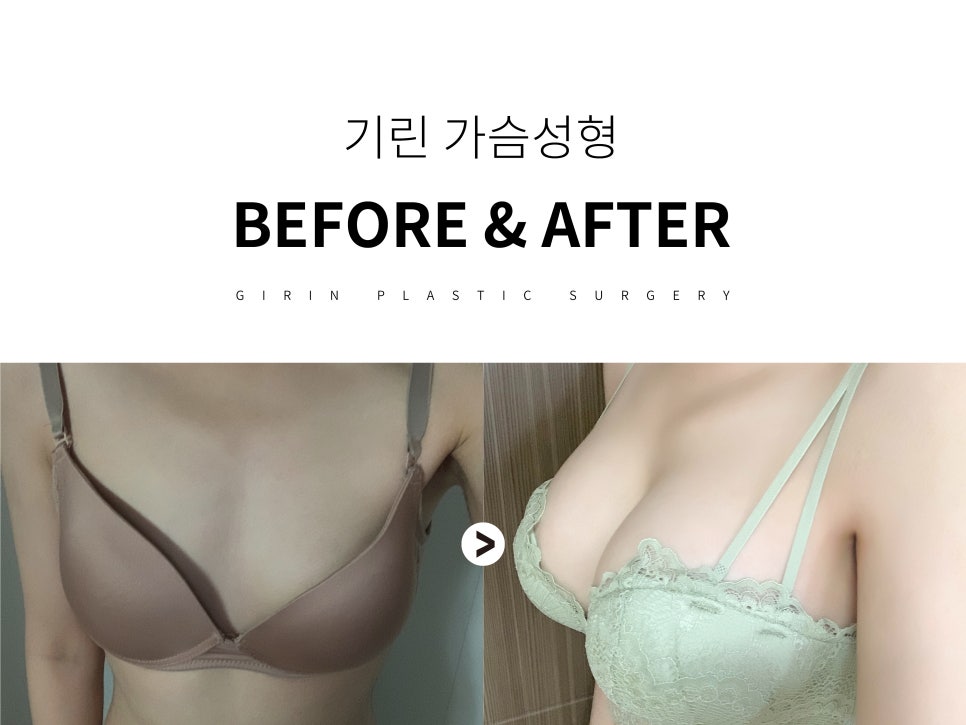 가슴성형잘하는곳 신중하게 보고 관련 이미지 10