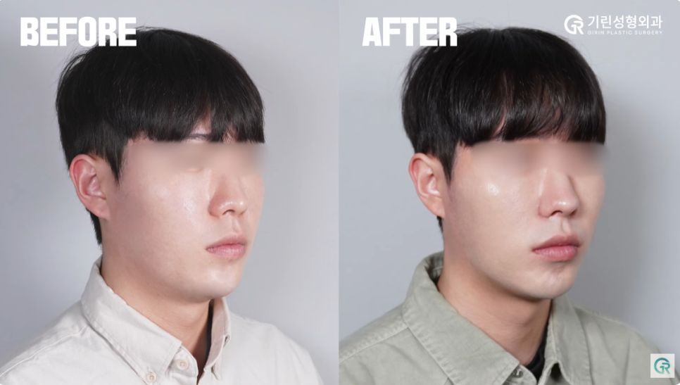 [기린성형외과의원] 수술 없이 턱라인 개선하기_인모드와 지방분해주사 관련 이미지 12