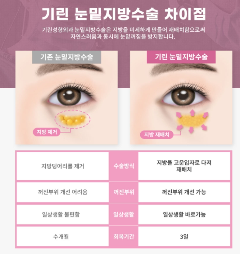 눈밑지방제거수술 하안검 선택의 폭이 넓어졌어요! 관련 이미지 8