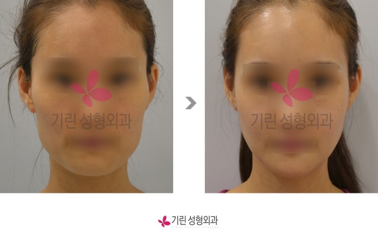 안면윤곽수술전후 : 긴곡선절제술과 광대축소 관련 이미지 1
