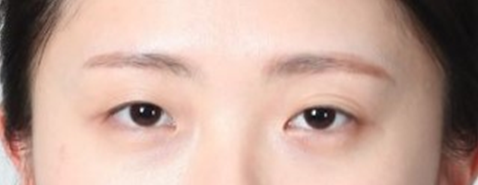 뒤트임 눈성형수술, 기린만의 특별화된 7mm 뒤트임. 관련 이미지 2