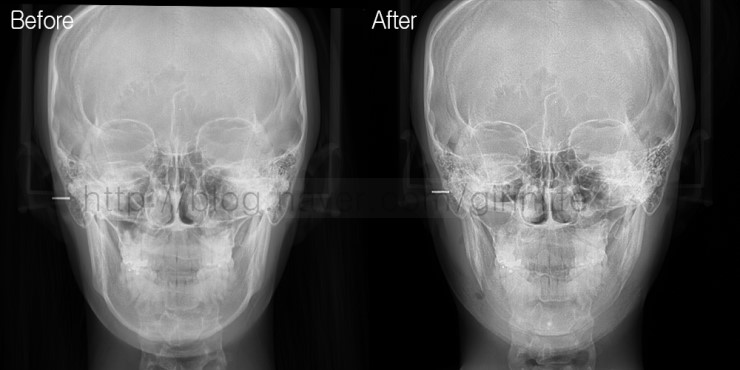 긴곡선절골로 앞턱길이를 함께 줄인 경우 관련 이미지 6
