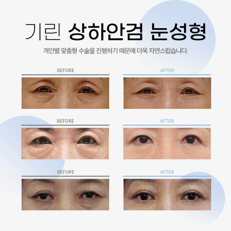 상안검수술잘하는곳 이유가 있다! 관련 이미지 6
