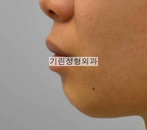 절골을 통한 무턱수술 전후 비교 관련 이미지 1