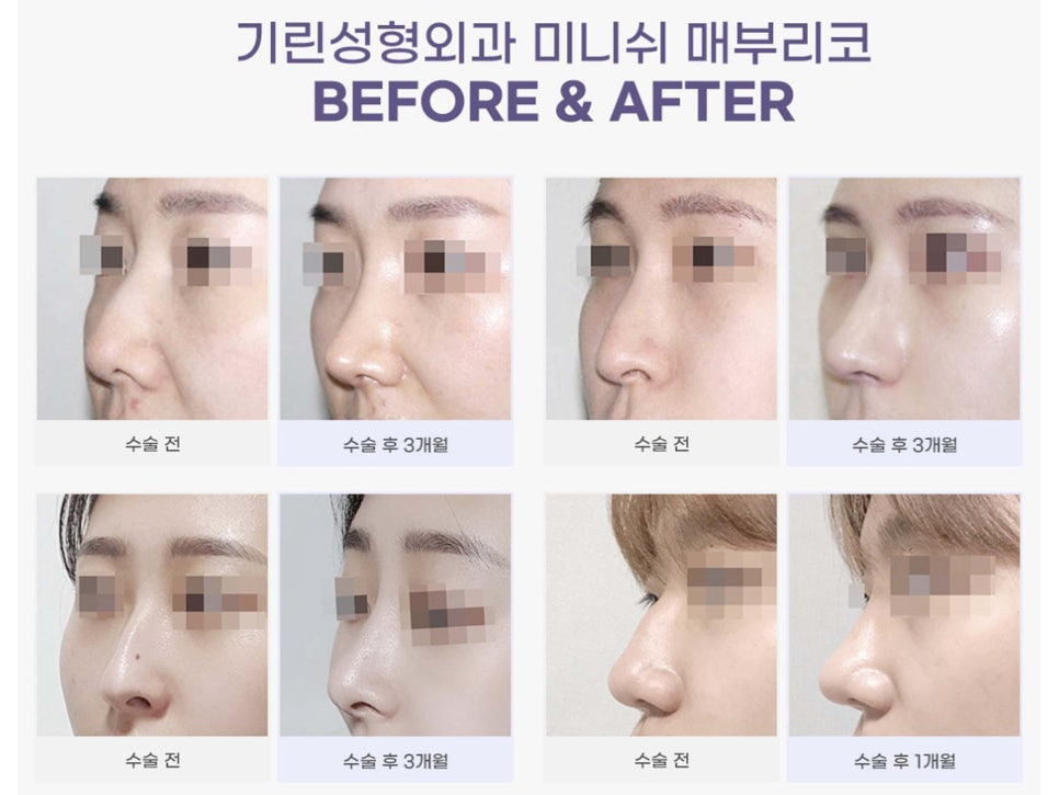 서울코수술 생김새에 따라 다르게 관련 이미지 5